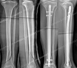 Fracture